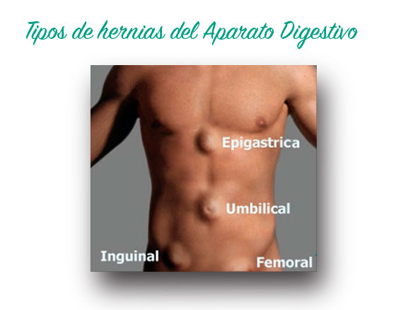 Tipos de hernias epigástricas